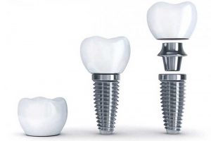 Dental Implant Services - Augusta Dental Arts