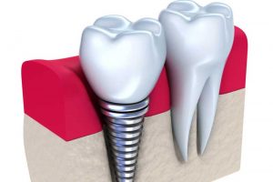 Dental Implant - Augusta Dental Arts